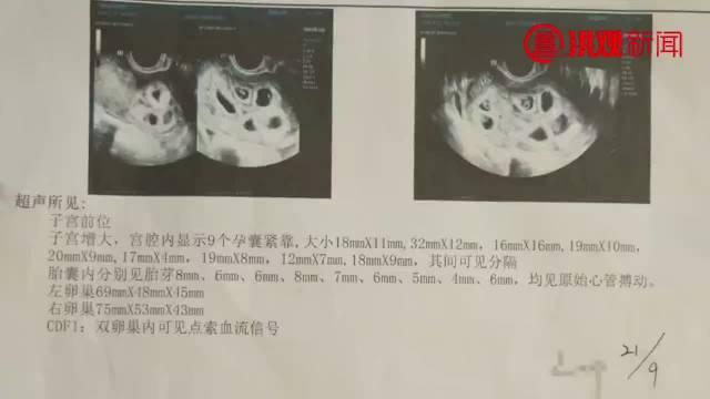 医学视角下的真相探寻，孕妇是否怀上九胞胎的医院未确认情况揭秘